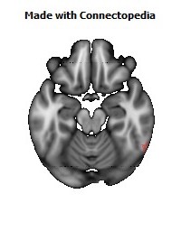 Superior_longitudinal_fasciculus_R126