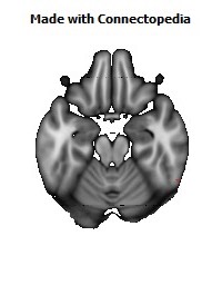 Superior_longitudinal_fasciculus_R128