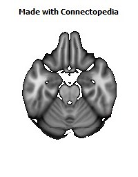 Superior_longitudinal_fasciculus_R130