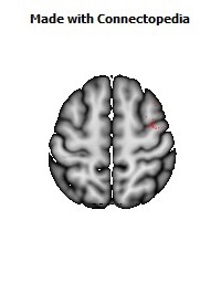 Superior_longitudinal_fasciculus_R052