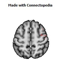 Superior_longitudinal_fasciculus_R054