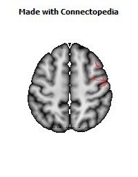 Superior_longitudinal_fasciculus_R056