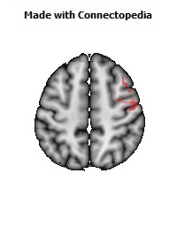 Superior_longitudinal_fasciculus_R058