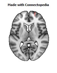 Uncinate_fasciculus_R100