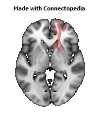 Uncinate_fasciculus_R108