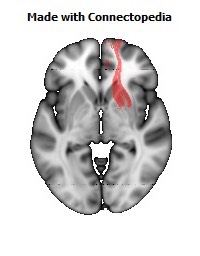 Uncinate_fasciculus_R110