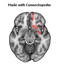 Uncinate_fasciculus_R120