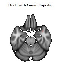 Uncinate_fasciculus_R132