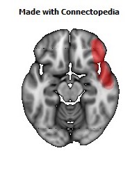 Vein_Superficial_Middle_Cerebral_R122
