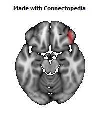 Vein_Superficial_Middle_Cerebral_R124